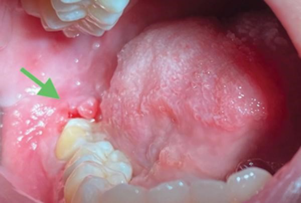 Các biến chứng tiềm ẩn khi mọc răng khôn Các biến chứng tiềm ẩn khi mọc răng khôn