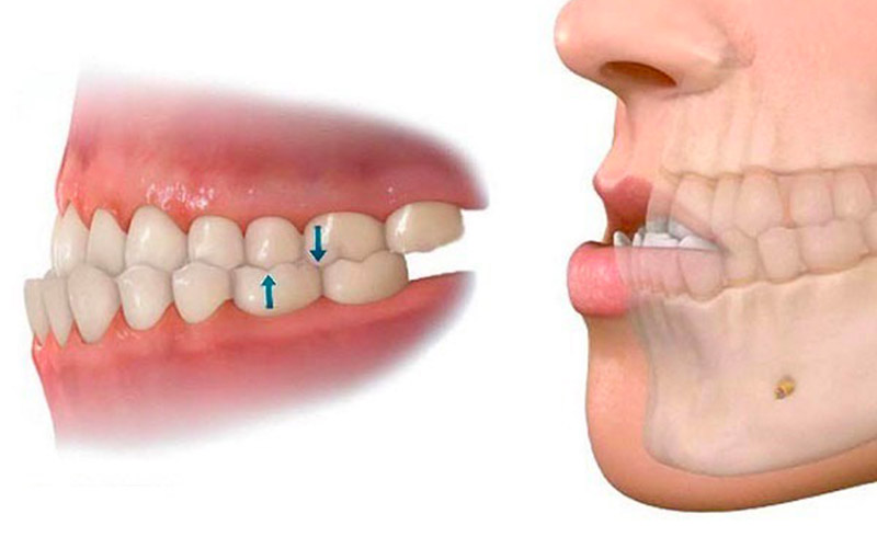 Nong hàm là gì? Nong hàm có thay đổi khuôn mặt hay không? Vòm hàm quá hẹp