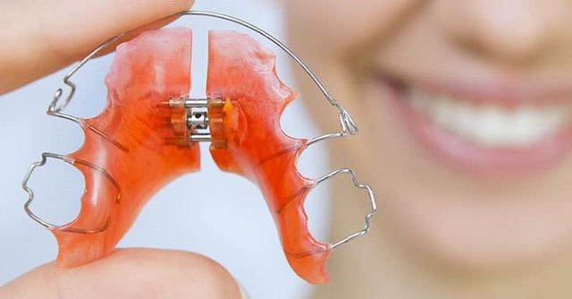 Nong hàm là gì? Nong hàm có thay đổi khuôn mặt hay không? Có thể lắp khí cụ nong rộng hàm cho hàm dưới không