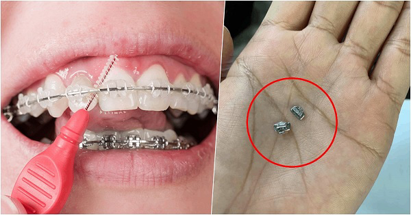 Nuốt mắc cài có thể viêm nhiễm khoang miệng