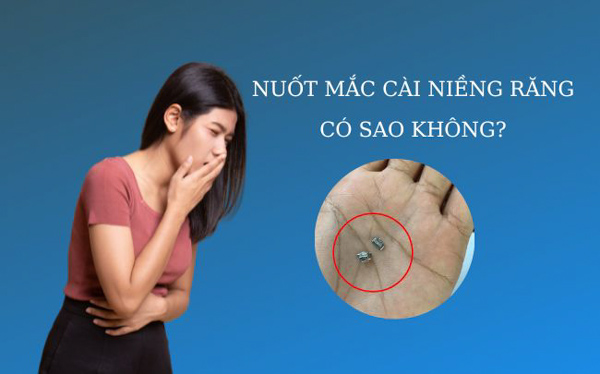 Nuốt mắc cài có thể gây ra tình trạng tổn thương vật lý lên dạ dày