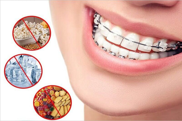 Sau khi niềng răng cần chế độ ăn uống phù hợp như thế nào?