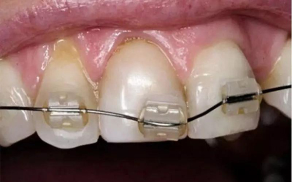 Bị bung rớt mắc cài khi niềng răng vì mắc cài kém chất lượng