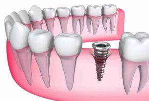 Tìm hiểu trồng răng Implant là gì?