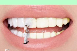 Bôi thuốc tẩy trắng lên răng
