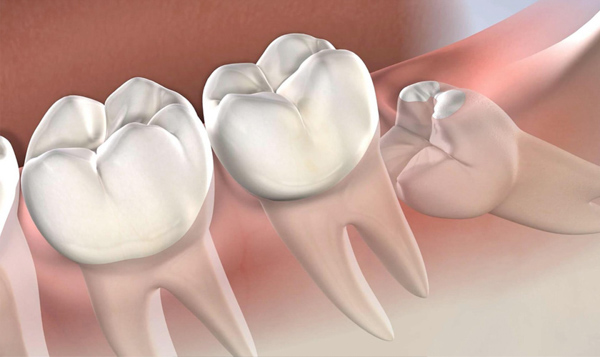 Răng khôn mọc lệch 90 độ có tác động đến sức khỏe răng miệng?