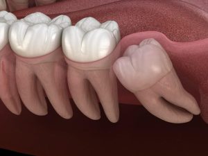 Những điều cần lưu ý khi mọc răng khôn lệch