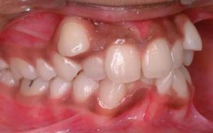 Tìm hiểu về răng mọc chồi là gì?