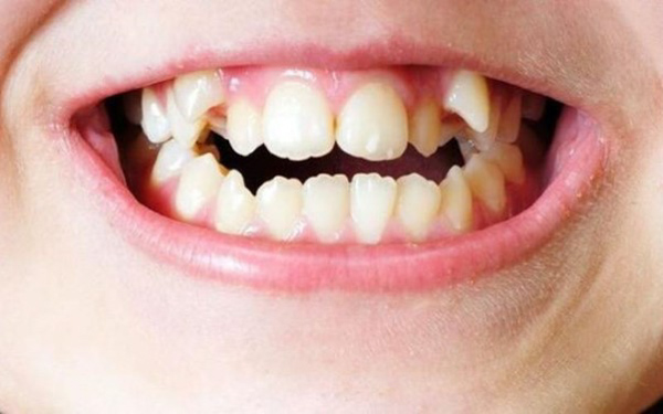 Răng mọc chồi bẩm sinh Răng mọc chồi bẩm sinh