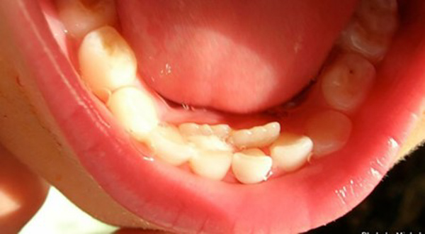Mọc răng mọc chồi là gì? Nguyên nhân và cách điều trị tốt nhất Thời điểm thay răng sữa không phù hợp