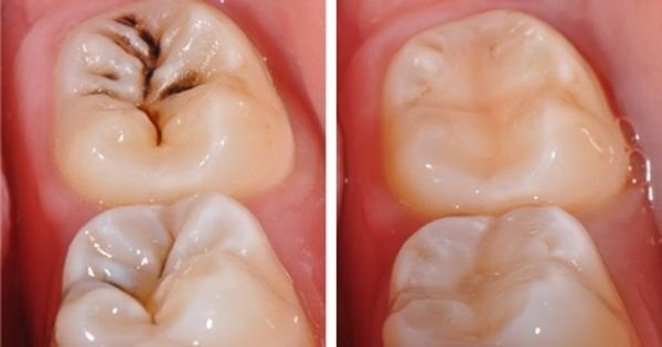 Trám răng như thế nào?
