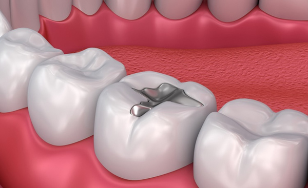 Quy trình trám răng gián tiếp diễn ra như thế nào?