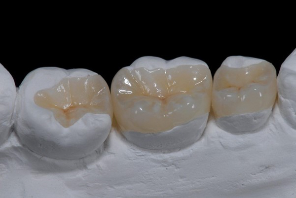 Trám răng bằng sứ inlay onlay