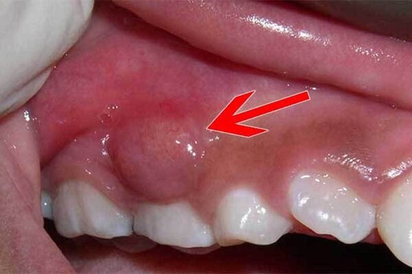 Dấu hiệu áp xe chân răng Dấu hiệu áp xe chân răng