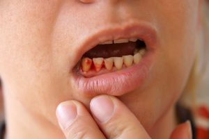 Hay bị chảy máu chân răng là bệnh gì?