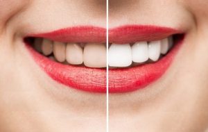 Có nên tẩy trắng răng không? Cách tẩy trắng răng hiệu quả