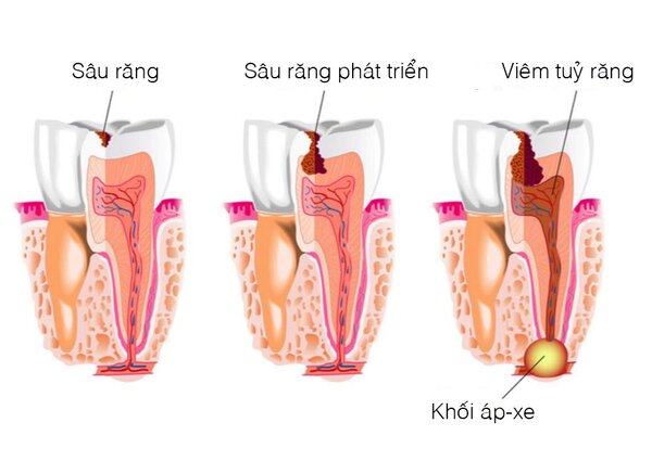 Một số nguyên nhân phổ biến gây nên tình trạng đau răng