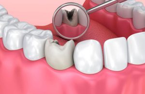 Lấy tủy răng tại Nha khoa Đồng