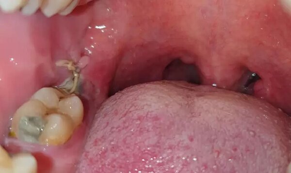 Xuất hiện mủ màu trắng là một trong những dấu hiệu cho thấy lỗ hổng sau khi nhổ răng khôn đã bị nhiễm trùng. Xuất hiện mủ màu trắng là một trong những dấu hiệu cho thấy lỗ hổng sau khi nhổ răng khôn đã bị nhiễm trùng.