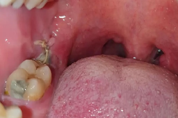 Nguyên nhân xuất hiện màng trắng sau khi nhổ răng cần biết