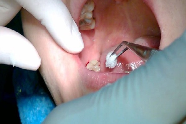 3 điều cần biết chăm sóc răng miệng sau khi nhổ