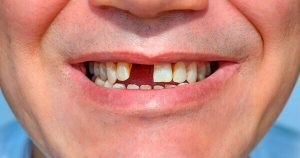 Để răng trống sau khi nhổ răng sẽ làm mất tính thẩm mỹ cho khuôn miệng của mình.