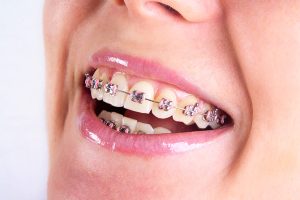 Nắn chỉnh răng là gì?