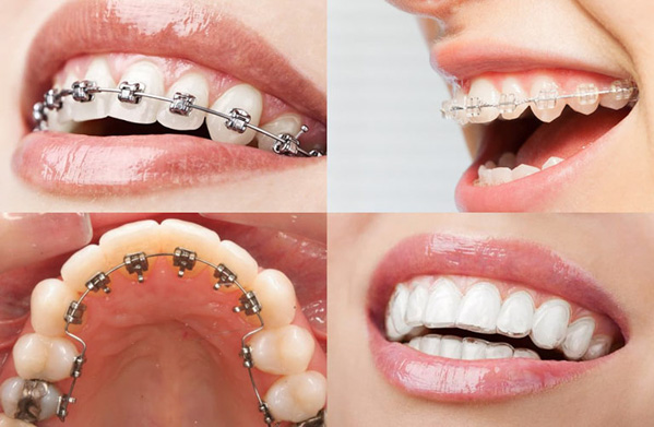 Tổng hợp các phương pháp nắn chỉnh răng hiệu quả Nắn chỉnh răng uy tín tại nha khoa Đồng