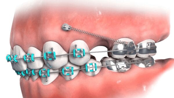Niềng răng có tác dụng gì? Niềng răng có tác dụng gì?