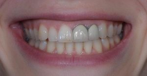 Bọc răng sứ Titan có bị đen viền nướu không?