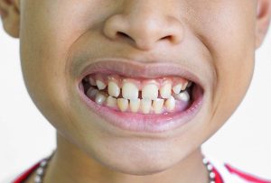 Khoảng trống giữa các răng