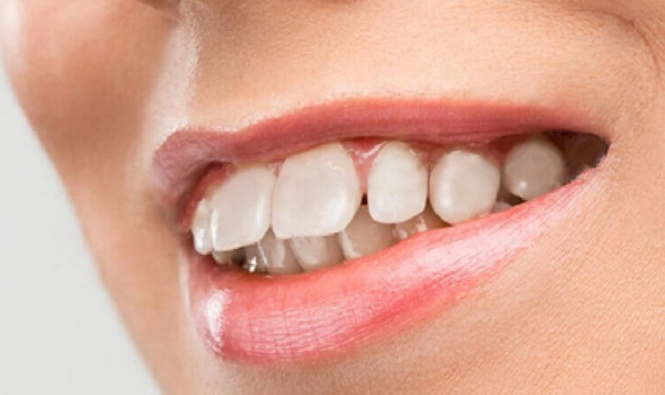 Răng vẩu hàm trên như thế nào?