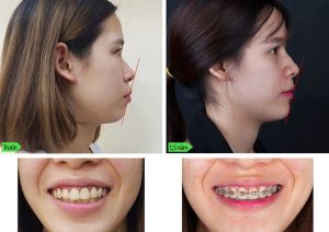 Răng vẩu là gì? Nguyên nhân và cách khắc phục hiệu quả