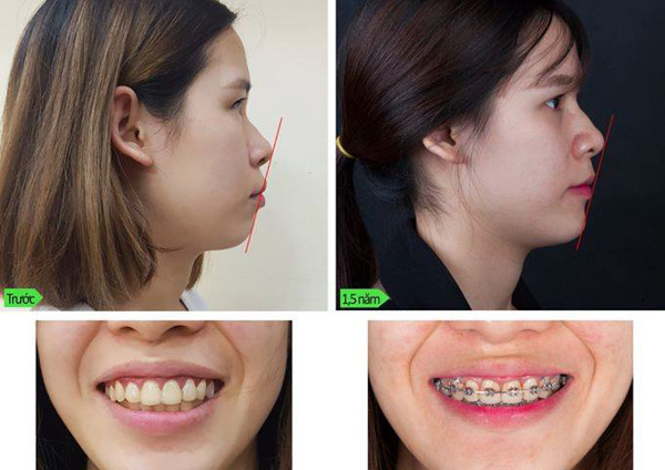 Có nên điều trị răng vẩu hay không?