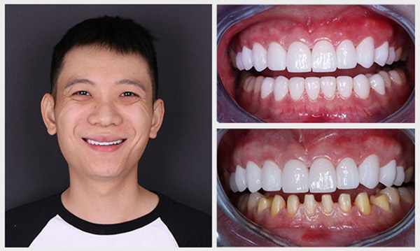 Mài răng điều trị răng vẩu