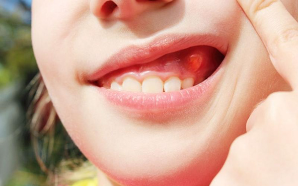 Sưng lợi (nướu răng) là gì?