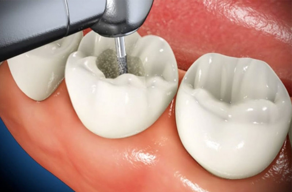 Lấy tủy răng trong trường hợp nhiễm trùng răng nghiêm trọng Lấy tủy răng trong trường hợp nhiễm trùng răng nghiêm trọng