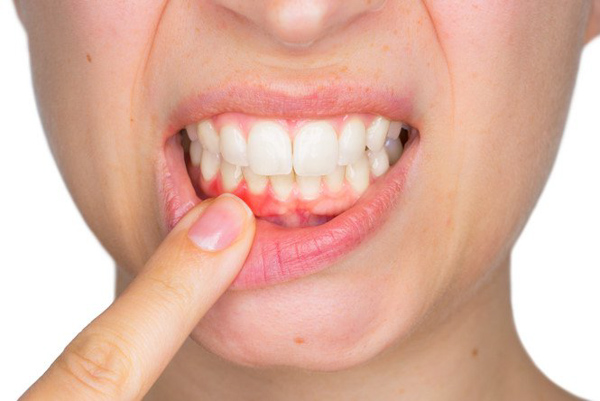 Dấu hiệu nhận biết đang bị sưng nướu răng Dấu hiệu nhận biết đang bị sưng nướu răng