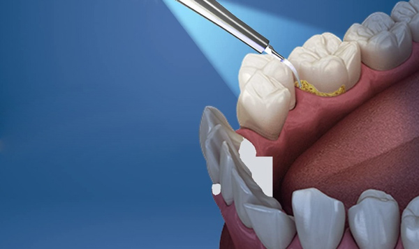 Cạo vôi răng bằng kỹ thuật đơn giản Cạo vôi răng bằng kỹ thuật đơn giản