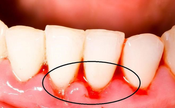 Tụt lợi gây chảy máu chân răng