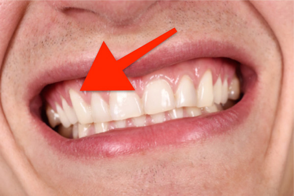 Những ai dễ bị tụt lợi chân răng