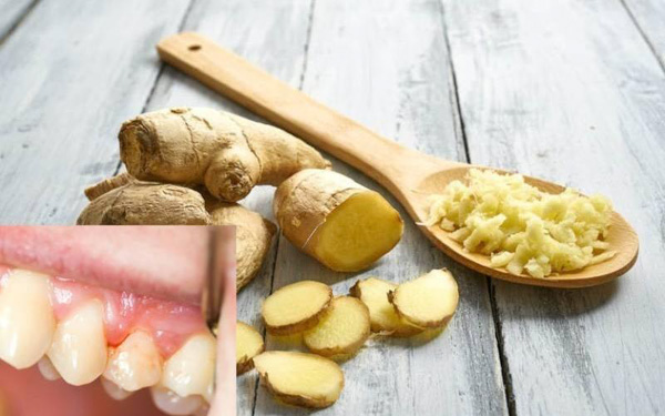Cách chữa viêm chân răng với gừng tươi Cách chữa viêm chân răng với gừng tươi