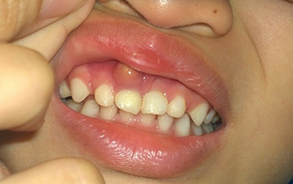 Rối loạn miễn dịch gây viêm chân răng Rối loạn miễn dịch gây viêm chân răng