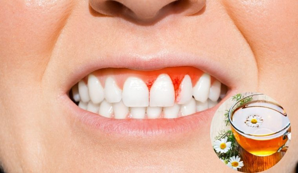 Điều trị viêm chân răng bằng hoa cúc Điều trị viêm chân răng bằng hoa cúc