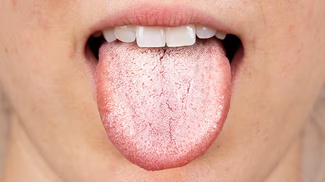 Lưỡi trắng là tình trạng lưỡi bị phủ lớp màu trắng thường đi kèm với mùi hôi miệng Lưỡi trắng là tình trạng lưỡi bị phủ lớp màu trắng thường đi kèm với mùi hôi miệng