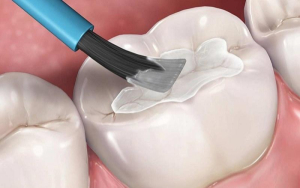 Có thể tự trám răng tại nhà không? Có nguy hiểm không?
