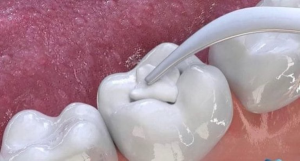 Đặt thuốc diệt tủy trong bao lâu? Có đau không?