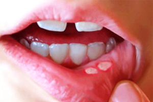 Nhiệt miệng là một tình trạng phổ biến mà trẻ em thường gặp phải