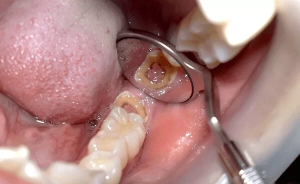 Lấy tủy răng giúp cứu răng bị viêm nhiễm, không gây mất răng và tránh ảnh hưởng xấu đến cấu trúc răng miệng Lấy tủy răng giúp cứu răng bị viêm nhiễm, không gây mất răng và tránh ảnh hưởng xấu đến cấu trúc răng miệng
