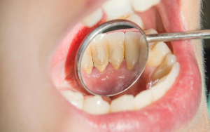 Hướng dẫn 25+ cách lấy cao răng tại nhà đơn giản bạn nên biết